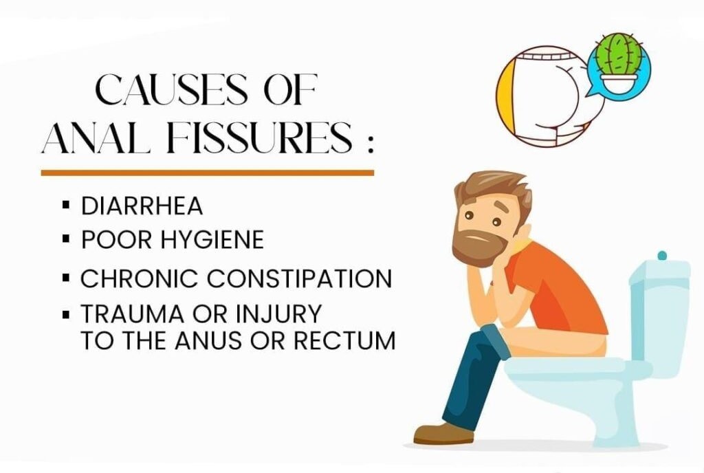 causes of anaal fissure 1024x872