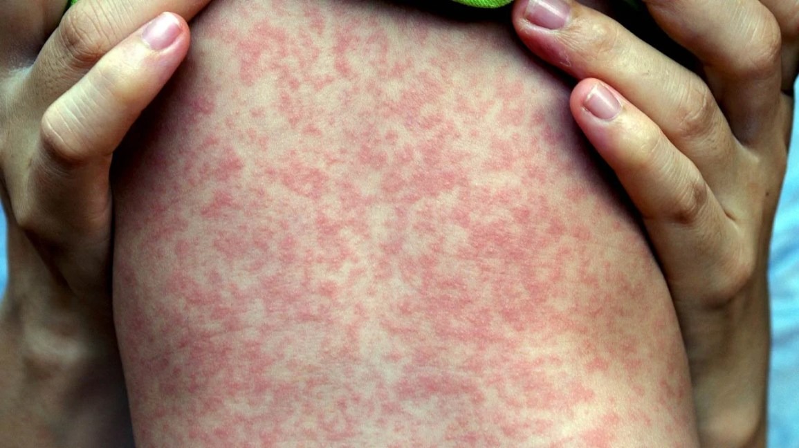 measles on the torso of a child