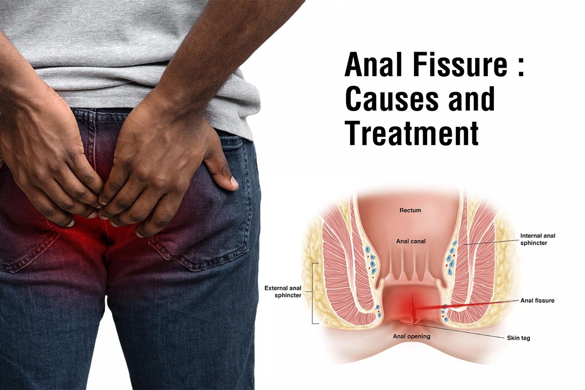 annular fissure treatment