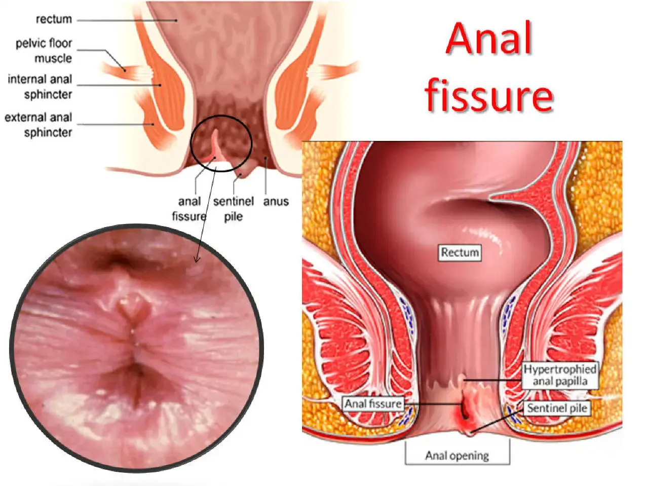 en anal fissure